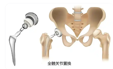 髖關(guān)節(jié)置換手術(shù)導(dǎo)航定位系統(tǒng)ropaplasty-01代理